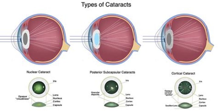 Cataract Basics and Beyond: Why Treatments Are Now Better Than Ever