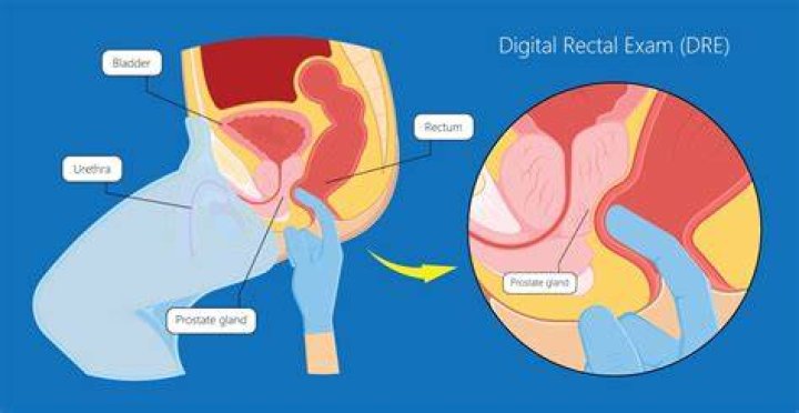 Digital Rectal Exam Fails as Screening Tool for Prostate Cancer