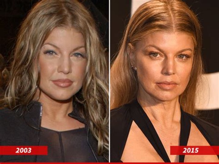 Fergie Plastic Surgery Before and After