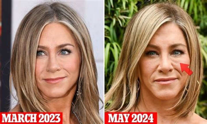 Jennifer Aniston Plastic Surgery: Decoding the Changes in Her Facial Features
